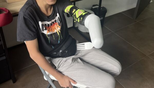 ENCAJA, System for Prosthetic Sockets, Wins James Dyson Award - 3Dnatives