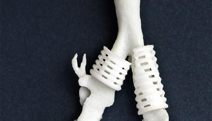 3D printed Splint