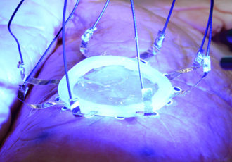3D printing onto expanding organs