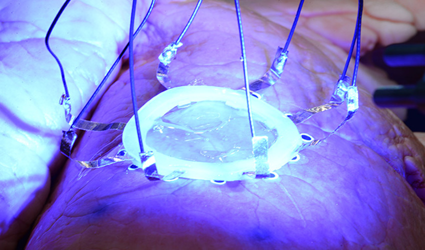 3D printing onto expanding organs
