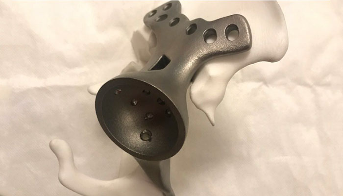 3D printed implants