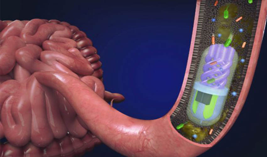 3D printed pill intestinal diseases