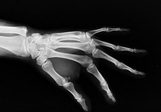 3D printed bone implants