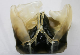 3D printing surgery