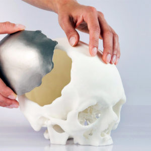 3D printed implants