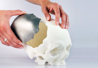 3D printed implants