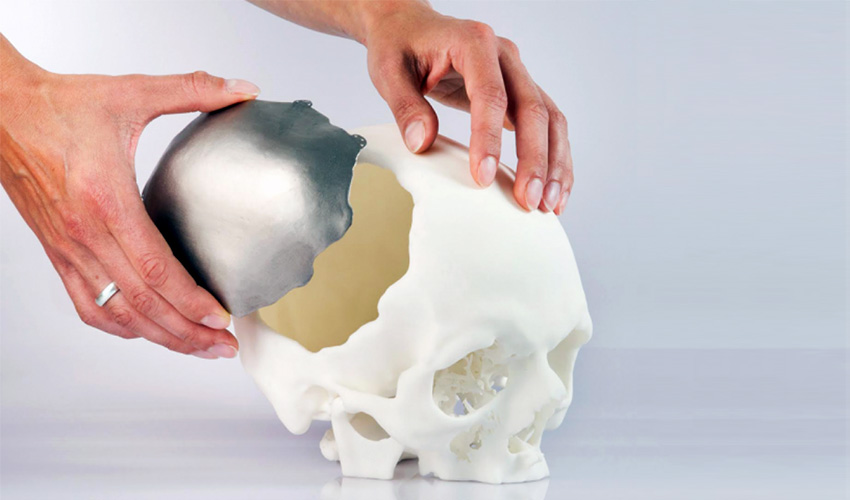 3D printed implants