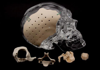 pekk implants
