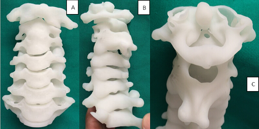 3D PRINTing SPINE