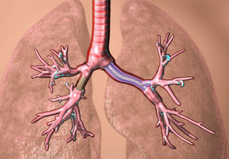 3d printed stents