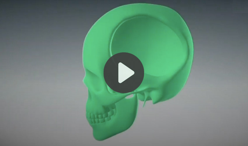 skull implant