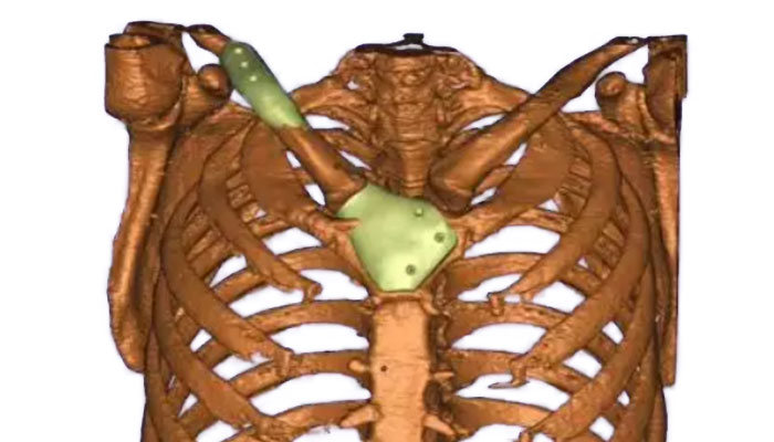 clavícula impresa en 3D