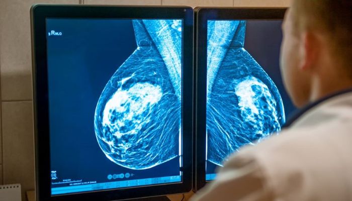 impresión 3D cáncer mama