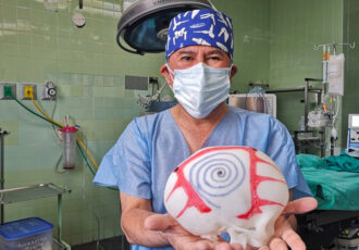 impresión 3D operación cráneo
