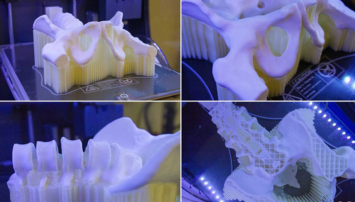 impresión 3D en el sector médico