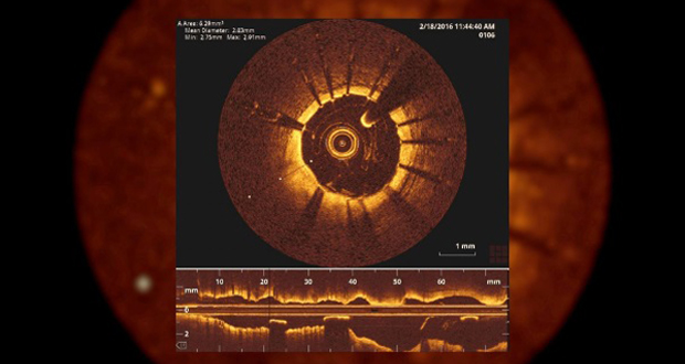 Cámara de alta resolución introducida dentro de las arterias de un paciente