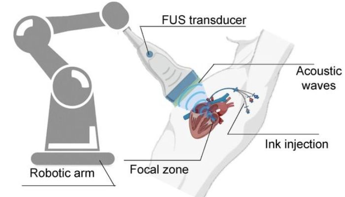 método para impresión 3D dentro del cuerpo humano