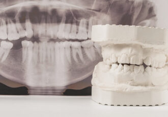 osteotomías faciales