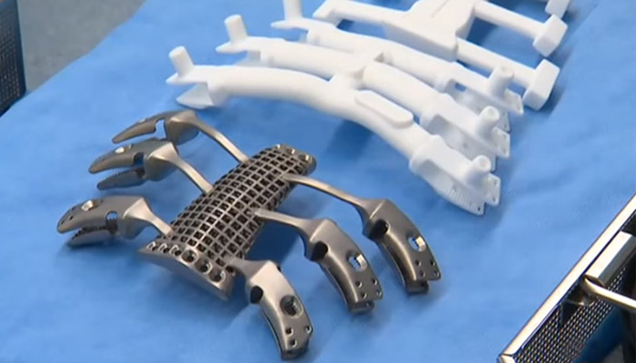 implante impreso en 3D