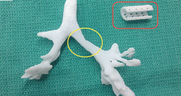Tráquea y férula impresa en 4D