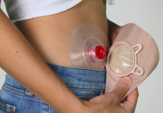 stampa 3d medicale