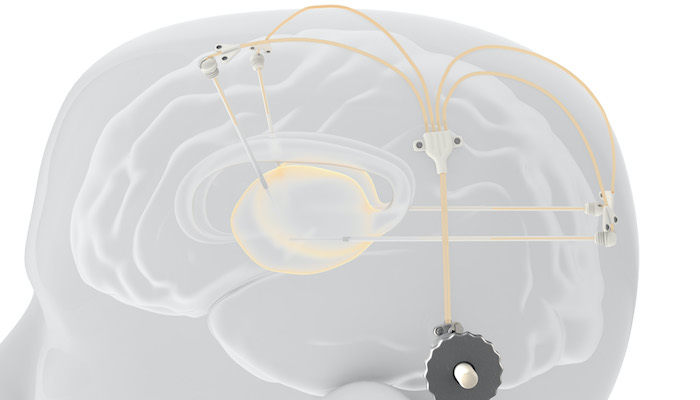 Implant medicament Parkinson