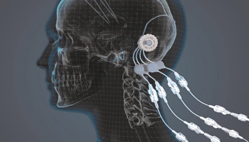 implant administration medicament 3D