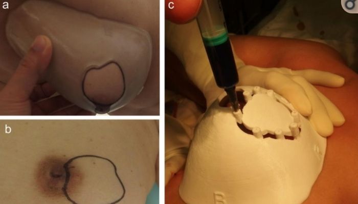 cancer du sein impression 3D