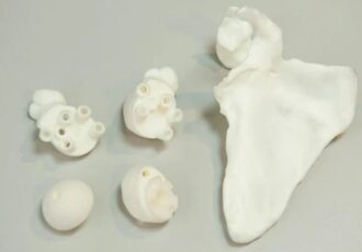 impression 3D planification chirurgicale