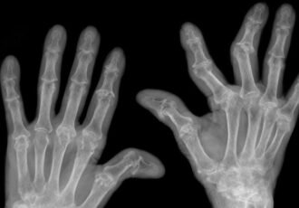 implants imprimés en 3D