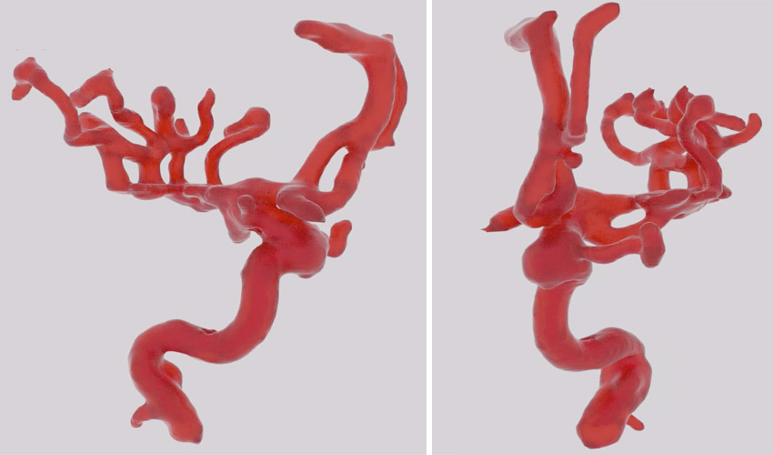 impression 3D silicone vascularisation