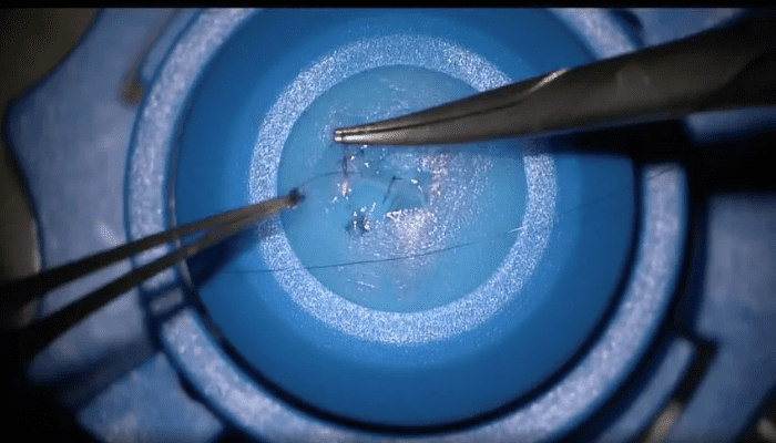 Impression 3D ophtalmologie