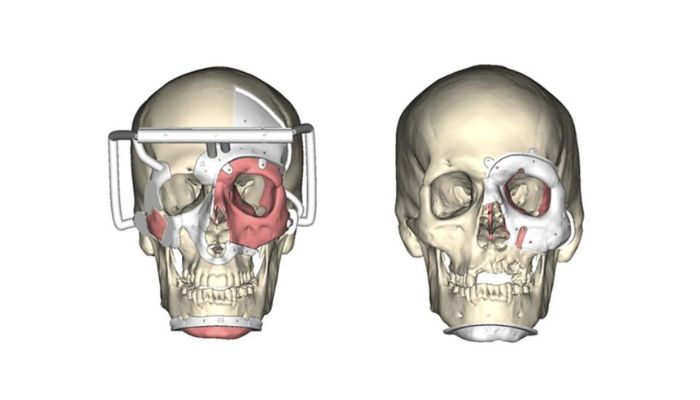 Impression 3D ophtalmologie