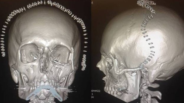 Pour recréer les modèles, l'équipe de chirurgien part d'un scan 3D du patient