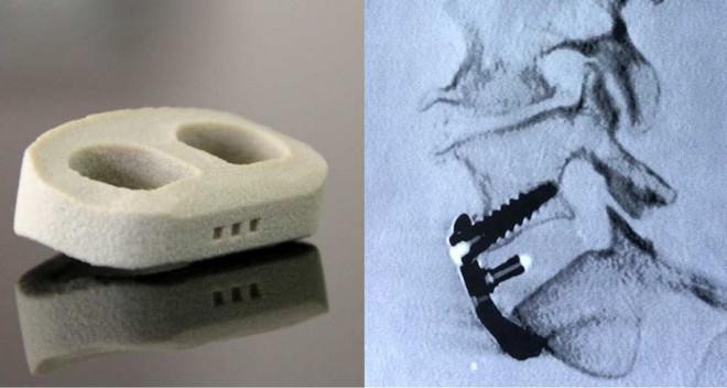L'implant imprimé en 3D mis au point par Medicrea