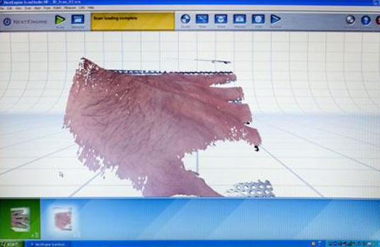 La première étape consiste à modéliser en 3D la blessure de la peau