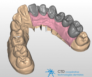 La conception des prothèses dentaires se fait de manière totalement numérique