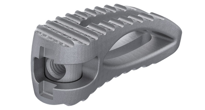 implant imprimé en 3D