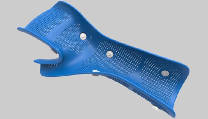 orthèses imprimées en 3D